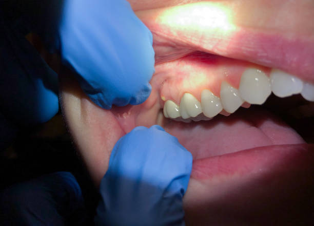 Best Emergency Dental Care for Sports Injuries in Chocowinity, NC